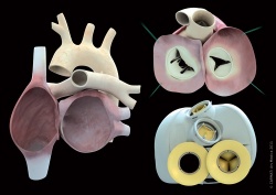 Photo: The first human implantations of  bioprosthetic artificial hearts