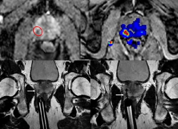 75-jähriger Patient mit ED eines Prostatakarzinoms 2011 (12 Proben, höchster...