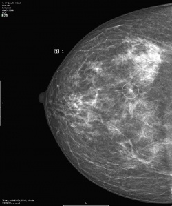 Photo: VuCOMP takes lead in aiding diagnosis of breast cancer