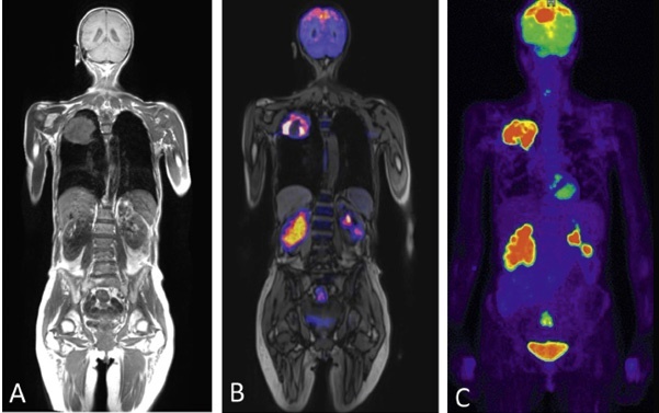 Figure 2: PET/MR hybrid whole-body imaging of a female patient with known...