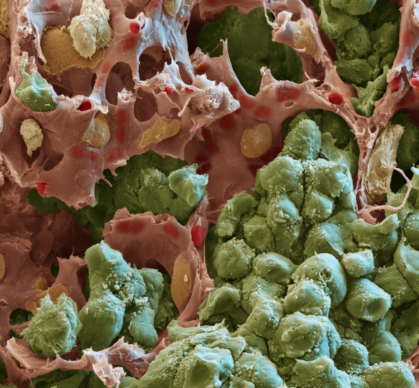 Scanning electron microscopic image of a lung metastasis: Tumor cells (green)...