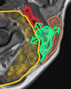 Compression effect (green arrows) of lesions in the posterior cervical space...