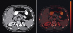 A control study of a liver metastasis after microwave ablation treatment: A...