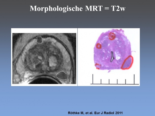 Vergleich MRT – Pathologie: Links morphologische T2-gewichtete MRT und rechts...