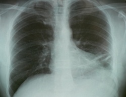 Photo: Test could identify resistant tuberculosis faster