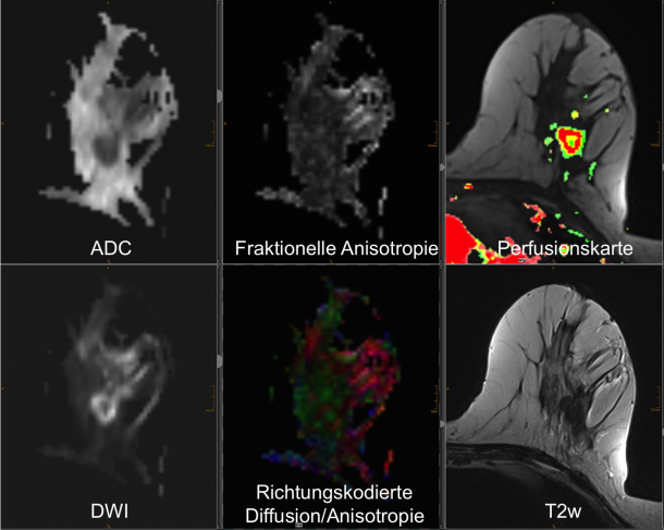 Multiparametric examination of the breast in a breast cancer patient; the...