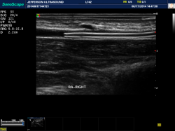 Ultrasound cross section of catheter post insertion in radial artery.
