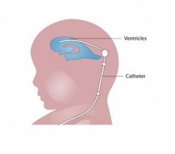 A blockage of the fluid inside the brains ventricles can result in a...