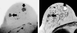 Images show example of a screening-detected lesion in a 51-year-old breast...