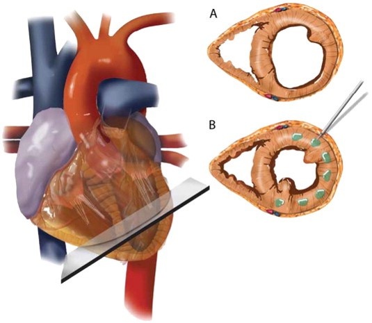 The implantation of Algisyl Hydrogel into the heart muscle modifies the wall...