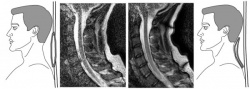 The MRI image on the left shows what the MRI scan can reveal when coil is only...