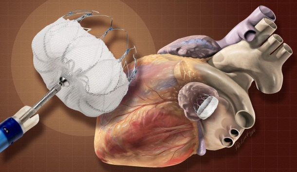 The Watchman device prevents blood clots from forming in the left atrial...