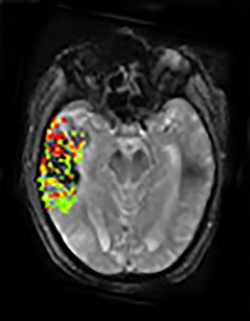 This image combines pre- and post-treatment scans from the same patient....