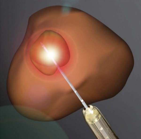 An illustration of laser ablation to treat prostate cancer.