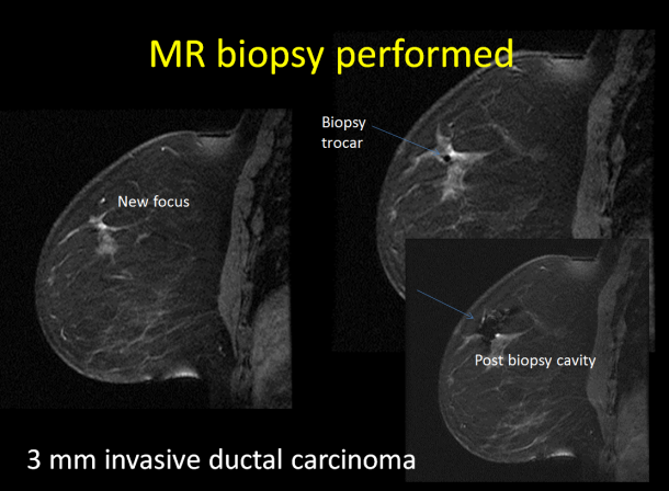 Photo: Mammography screening with MR