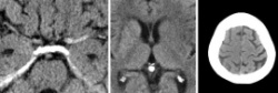 Fig. 1: Early signs of infarct in the native CT.
L to R: signs of densemiddle...