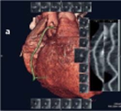 Fig. 4: Case examples for 3D heart construction with: a) heart frequency = 45 -...