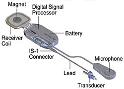 Photo: Innovative solution for hearing loss