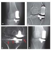 Fig. 1: Post-surgical images of bilateral total hip replacement
Due to...