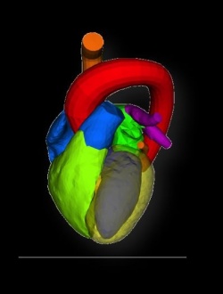 Photo: Aortic valve replacement in the third dimension