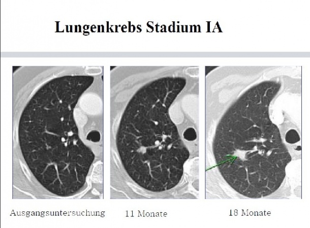 Kann Man Im Ct Lungenkrebs Erkennen www.healthcare-in-europe.com