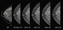 3-D Mammography (Breast Tomosynthesis)