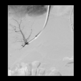 Successful puncture of a portal vein branch through the liver parenchyma.