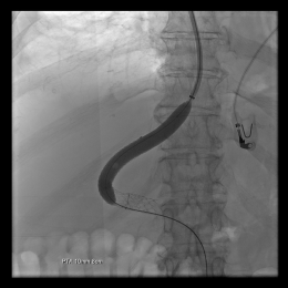 After insertion of a stable wire into the portal vein system a specially coated...