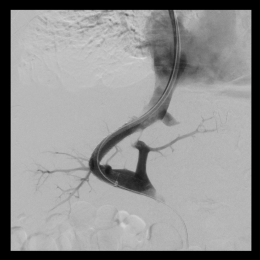 Successful pressure reduction in the portal vein system through the insertion...