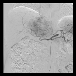 Classic tumour blush in angiography.