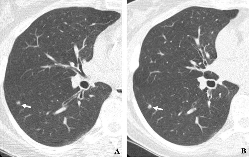 Two annual repeat low-dose CT scans in a woman who was 60 years old at baseline...
