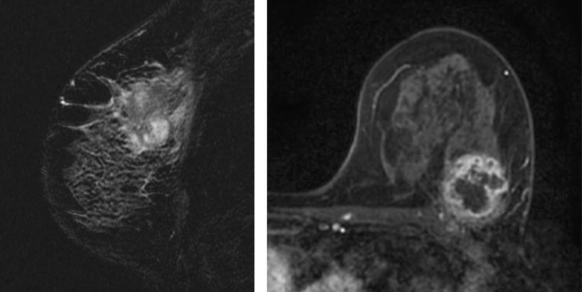 High intratumoral intensity and necrosis in triple-negative tumour subtypes.