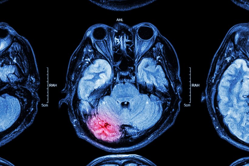 medical imaging scan of brain, red area indicating damage from stroke