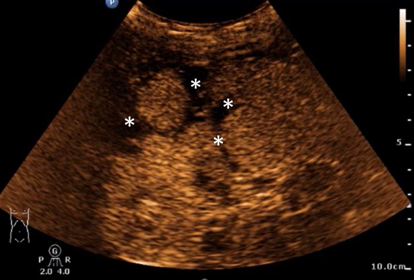 Example of liver lacerations (stars) with contrast enhanced ultrasound (CEUS)
