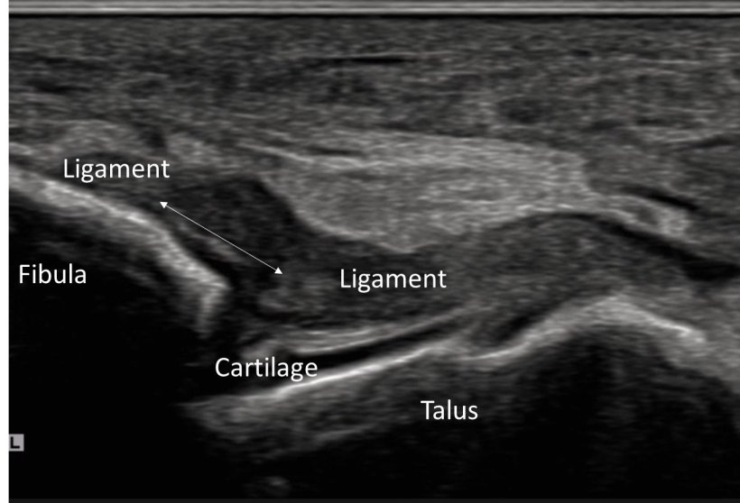 Example of rupture (arrow) of anterior talo-fibular ligament