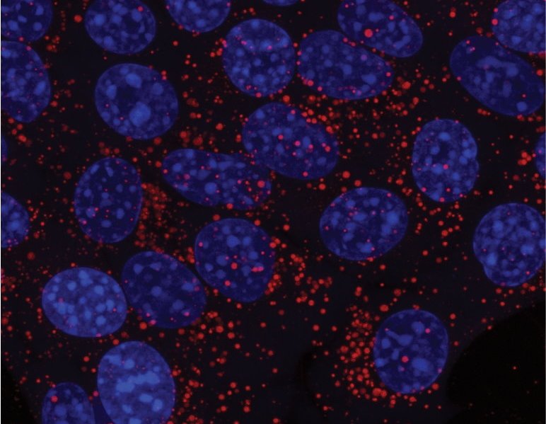 Fluorescent image of cancer cells (cell nuclei in blue) stockpiling lipids in...