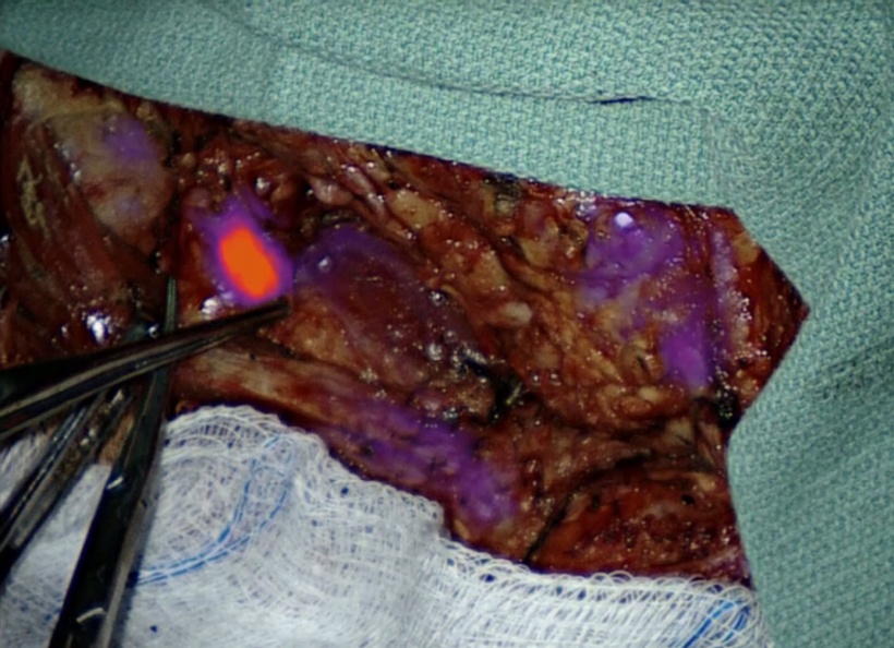 A lymph node glows during surgery.