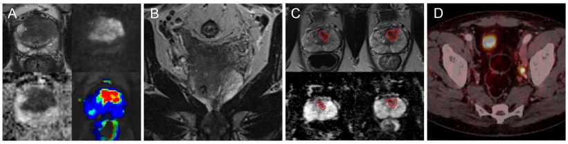 Diagnostic images of a patient with prostate cancer