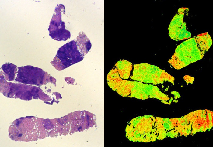 A traditional stained biopsy (left) and a Digistain view (right)