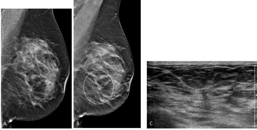 Mediolateral oblique views of left breast in a 67-year-old woman. A, Mammogram...