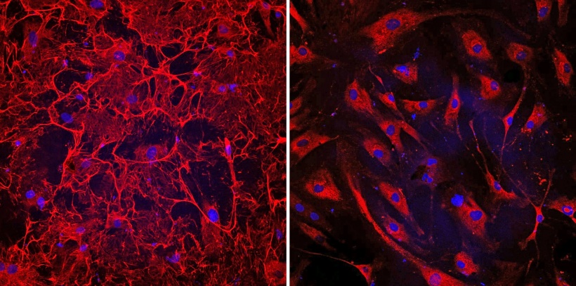 Right image: This microscopic image shows donated fibrotic heart cells from a...