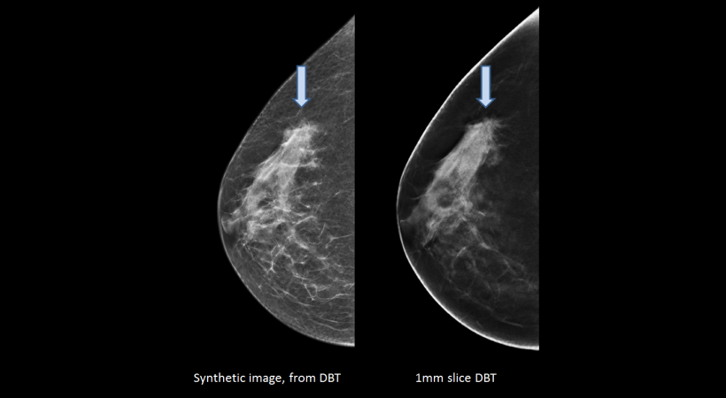 mammography image comparison of digital mammography and tomosynthesis