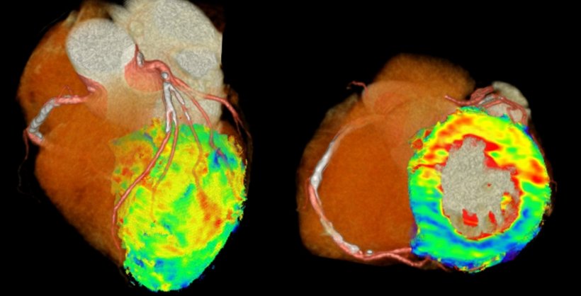 Figure 1: 4D-CT perfusion images of the heart