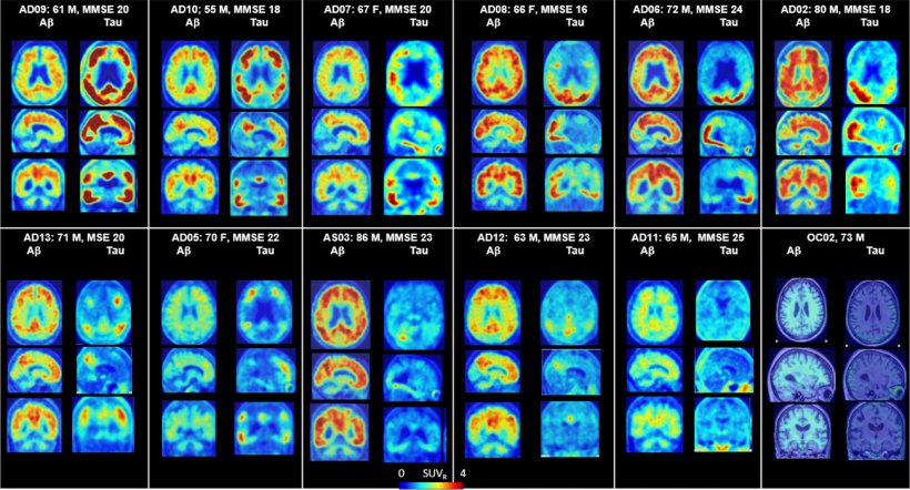 PET scans of human brain
