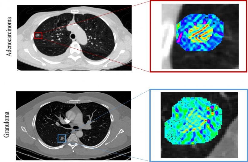 Unique radiomic signatures from intra- and peri-nodular regions on CT imaging...