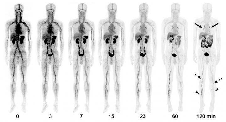 18F-GP1 PET/CT and CT images of 55-y-old man with DVT and PE. Anterior...