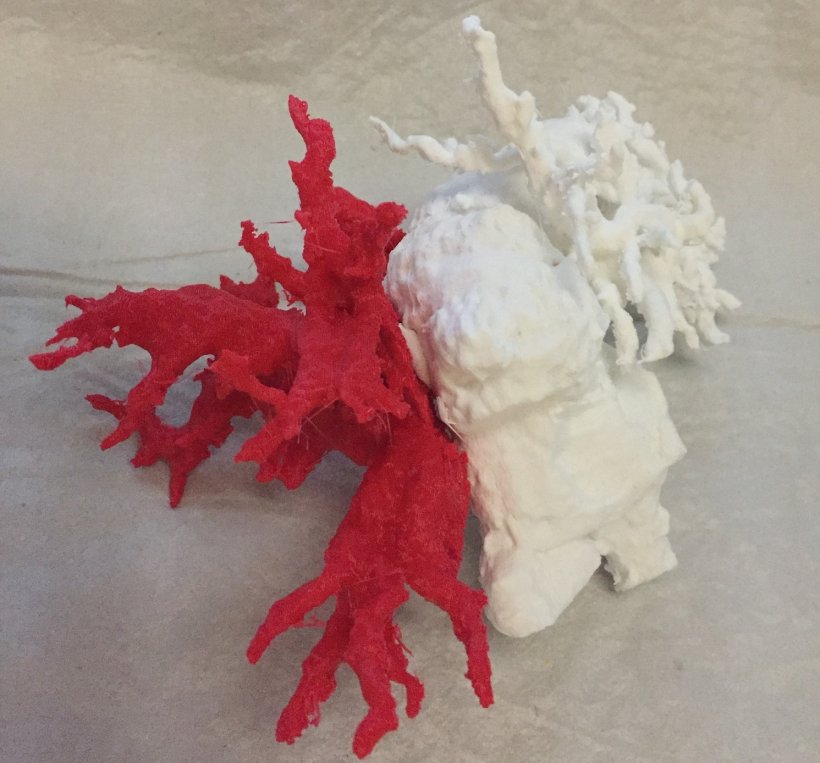 3D-printed visualization of the left and right massively dilated biliary system...