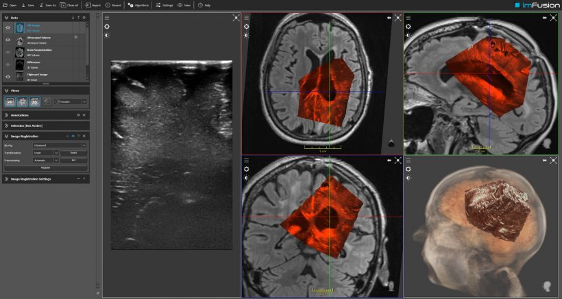 ImFusion uses deep learning to turn 2-D ultrasound data into 3-D images