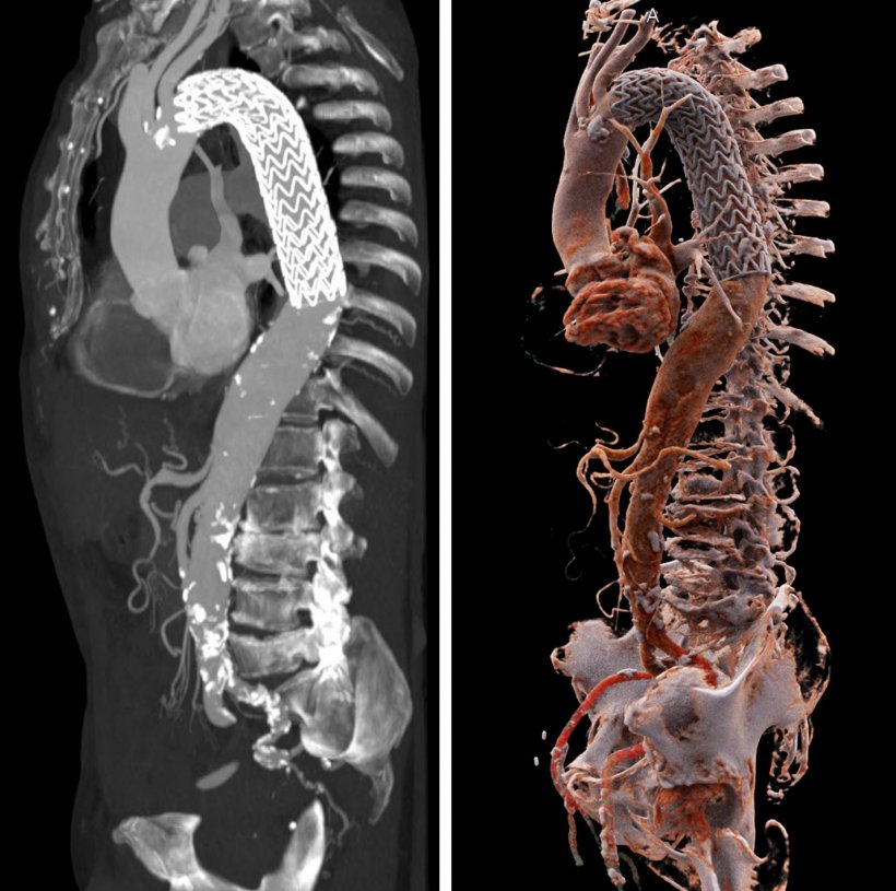 Kontrast nach Maß bei der CT-Angiografie