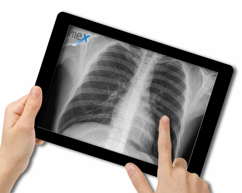 Image of a tablet with an x-ray image of the ribcage